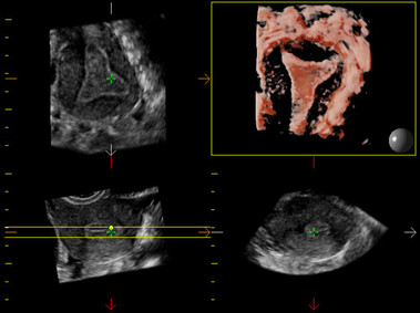 Clinical Image - MyLab<sup>™</sup>Eight Platform - Volumetric Imaging
