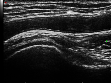 Clinical Image - MyLab<sup>™</sup>Twice - Axillary arteritis
