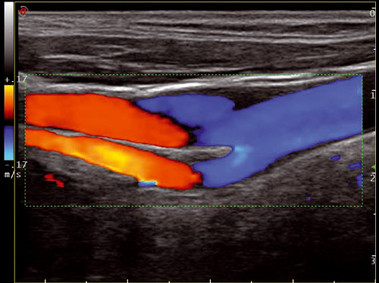 Clinical Image - MyLab<sup>™</sup>Twice - Carotid Artery