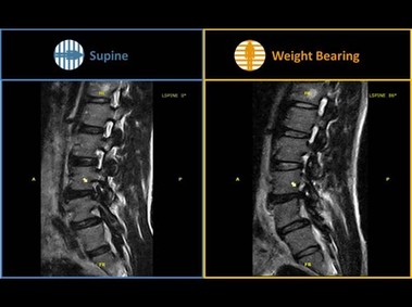 G-scan Brio – Выпячивание диска