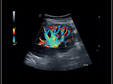 Image clinique - MyLab<sup>™</sup>Sigma: Kidney perfusion with high sensitivity Color Doppler mode