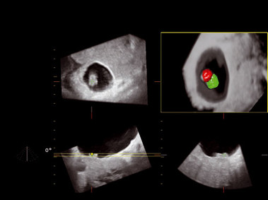 Clinical Image - MyLab<sup>™</sup>Twice - Ob/Gyn (4D view)