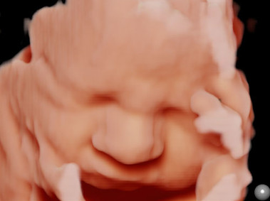 Clinical Image - MyLab<sup>™</sup>Eight eXP - 4D Imaging Obstetrics (XLight)