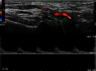 Clinical Image - MyLab<sup>™</sup>Twice - Temporal arteritis - CFM and PW
