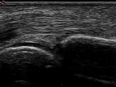 Clinical Image - MyLab<sup>™</sup>Seven - Metacarpal Head