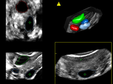 Clinical Image - MyLab<sup>™</sup>Eight Platform - 3D Imaging - (VRA)