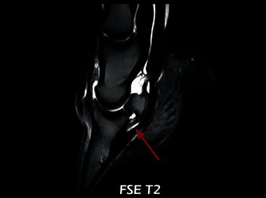 Clinical Image - O-scan equine: Lesion of the collateral ligaments of the coffin joint