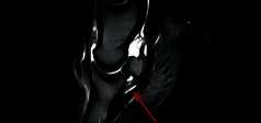 Clinical Image - O-scan equine: Lesion of the collateral ligaments of the coffin joint