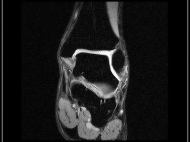O-scan - Ankle - XBone Coronal