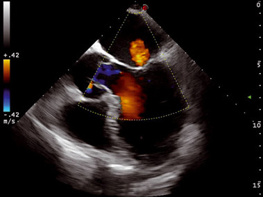 Clinical Image - MyLab<sup>™</sup>Seven - Heart (TEE)