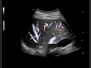 Imagen clínica - MyLab<sup>™</sup>9 Platform - Mejora de Doppler XFlow en vascularización del hígado