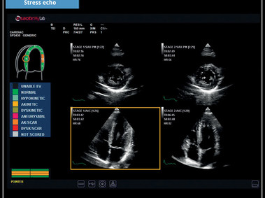 Клиническое изображение - MyLab<sup>™</sup>X6: технология Stress Echo