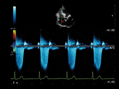 Clinical Image - MyLab<sup>™</sup>Alpha - Heart (CW Doppler Imaging)