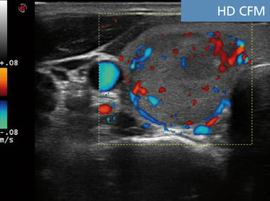 Clinical Image - MyLab<sup>™</sup>Seven - HD CFM Imaging
