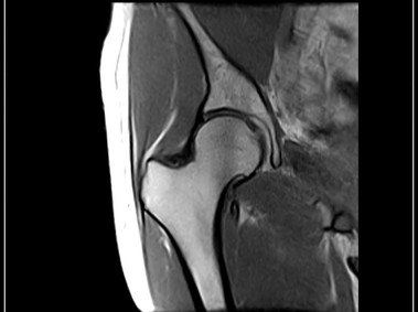G-scan Brio - Hip - SE T1 Coronal