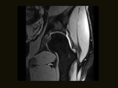 S-scan - Hip X BONE T2 Coronal