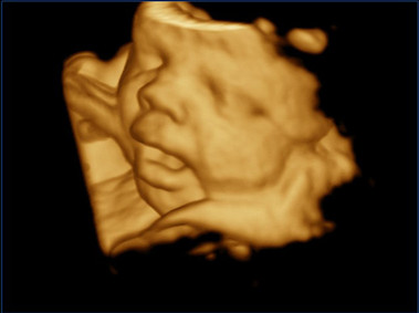Clinical Image - MyLab<sup>™</sup>Twice - Baby Face (X4D Imaging)