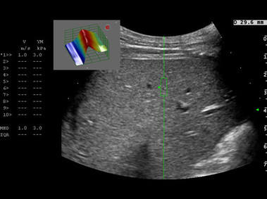 Clinical Image - MyLab<sup>™</sup>Eight Platform - Shearwave Elastography