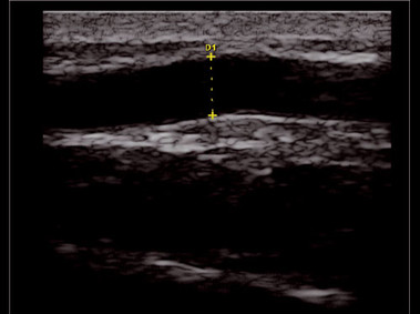 Clinical Image - MyLab<sup>™</sup>Twice - Very Small Superficial Lesion 2