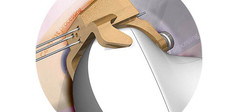 ABS42X3 - Three-Needle Kit for Thermoablation