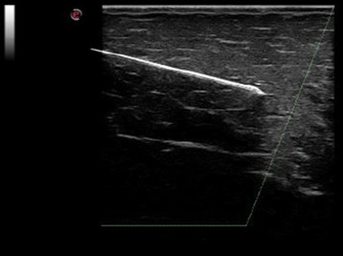 Clinical Image - MyLab<sup>™</sup>Alpha - Needle Enhancement