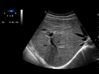 Clinical Image - MyLab<sup>™</sup>Eight Platform - Single Crystal Abdominal Imaging