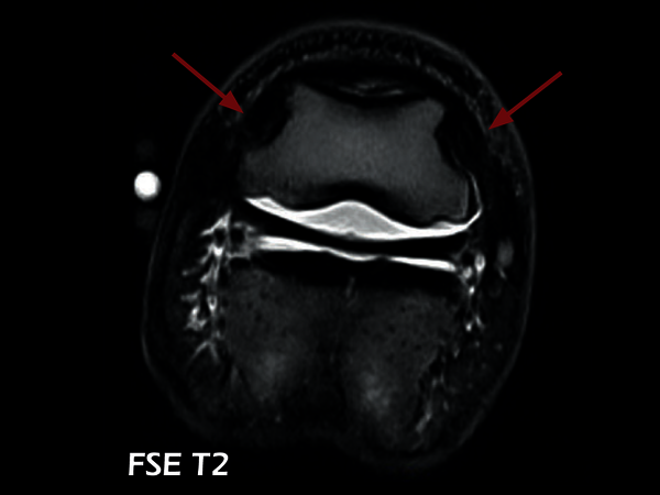 Clinical Image - O-scan equine: Lesion of the collateral ligaments of the coffin joint