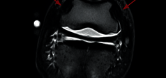 Clinical Image - O-scan equine: Lesion of the collateral ligaments of the coffin joint