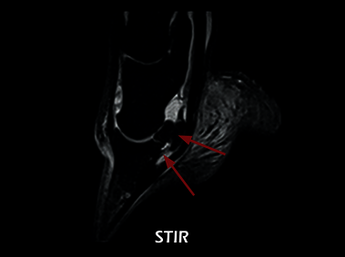 Clinical Image - O-scan equine: Lesion of the collateral ligaments of the coffin joint