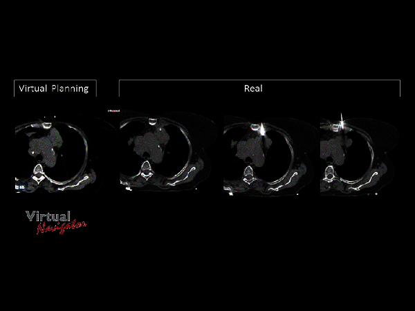 Clinical Image - MyLab™Eight eXP - Lung Biopsy Virtual Planning vs Real Placement