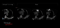 Clinical Image - MyLab™Eight eXP - Lung Biopsy Virtual Planning vs Real Placement