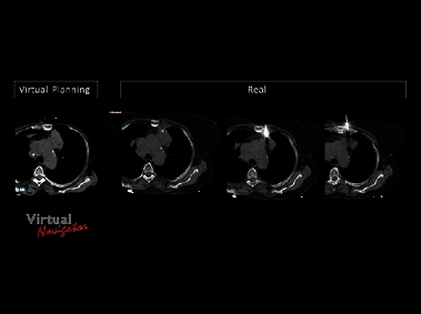 Clinical Image - MyLab<sup>™</sup>Eight eXP - Lung Biopsy Virtual Planning vs Real Placement