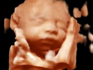Clinical Image - MyLab<sup>™</sup>Omega - BabyFace using XLight