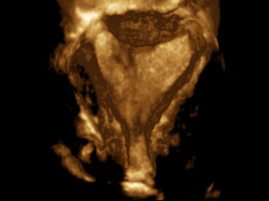 Clinical Image - MyLab<sup>™</sup>Eight Platform - 3D Imaging - Gynaecology