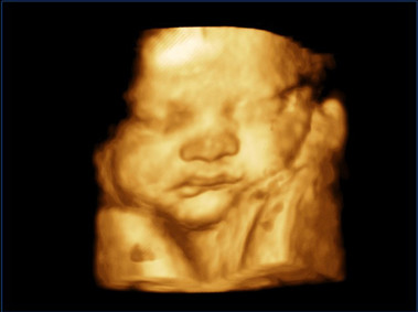 Clinical Image - MyLab<sup>™</sup>Twice - Baby Face (X4D Imaging)