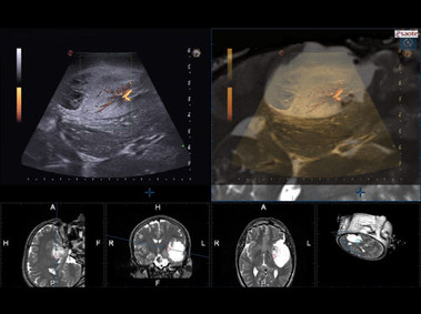 Clinical Image - MyLab<sup>™</sup>Eight Platform - Neurosurgery and Neurosonology optimized by Virtual Navigator