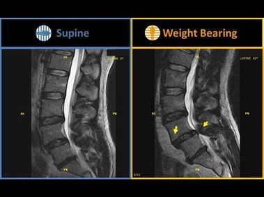 G-scan Brio - Spondylolisthesis