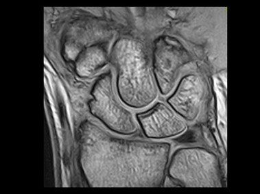 O-scan - Wrist GE Coronal