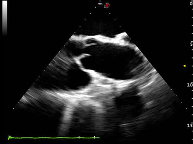 Clinical Image - MyLab<sup>™</sup>Eight Platform - Heart (TEE)