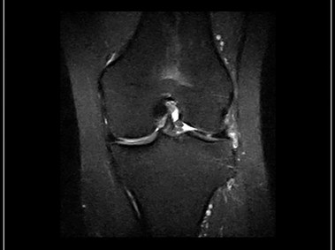 O-scan - Knee - FSTIR Coronal