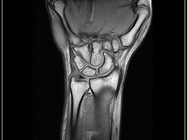 O-scan - Wrist - GE T1 Coronal