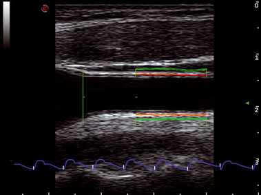 Clinical Image - MyLab<sup>™</sup>Seven - Carotid Artery (QIMT & QAS)