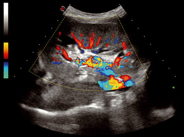 Clinical Image - MyLab<sup>™</sup>Seven - Kidney Vascularization