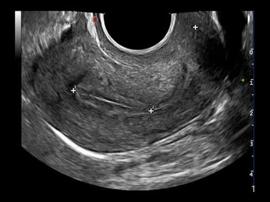 Clinical Image - MyLab<sup>™</sup>Alpha - Uterus (XView & MView Imaging)
