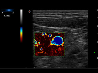 Clinical Image - MyLab<sup>™</sup>Twice - High Sensitive Hemodynamics Analysis