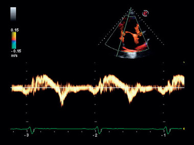 Immagine clinica - MyLab<sup>™</sup>Six - Doppler del tessuto cardiaco (imaging TVM)