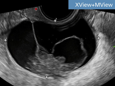 Clinical Image - MyLab<sup>™</sup>Seven - XView & MView Imaging