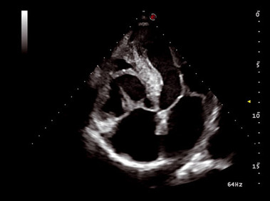 Clinical Image - MyLab<sup>™</sup>Seven - Heart Four Chambers (XView Imaging)