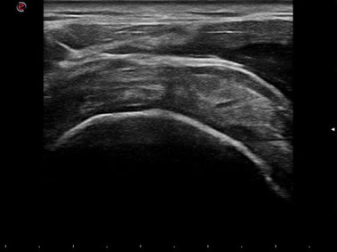 Clinical Image - MyLab<sup>™</sup>Gamma - Supraspinatus