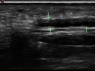 Clinical Image - MyLab<sup>™</sup>Seven - Digital Artery Palm